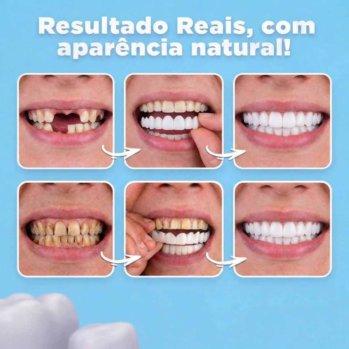 Lumiere White — Facetas Removíveis Premium